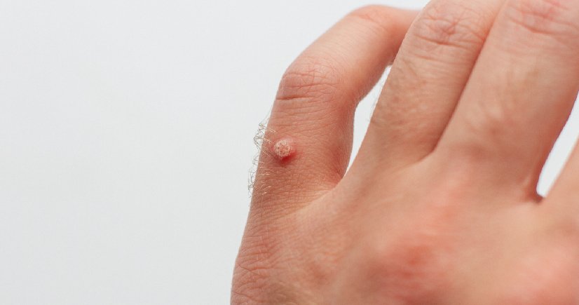 wart removal treatment​ in Banashankari, Bangalore 